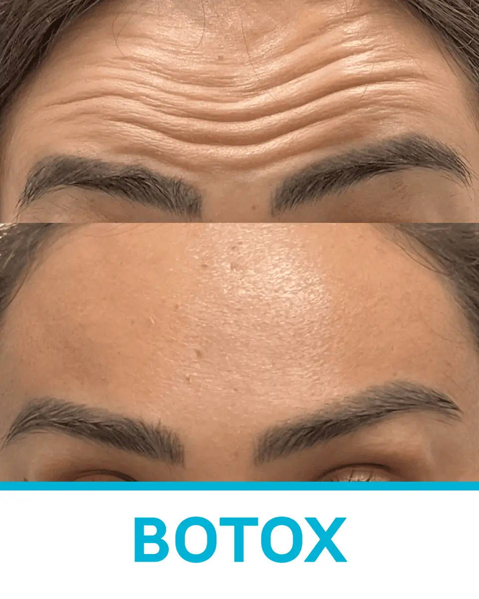 Antes y después de tratamiento de Botox en frente, paciente real de Clínica Goyenechea