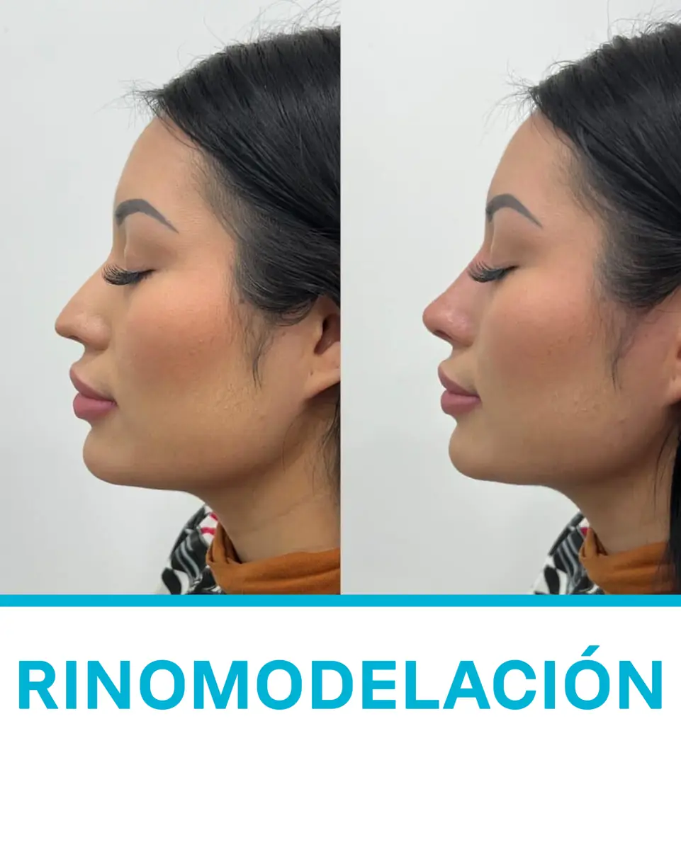 Antes y después de rinomodelación sin cirugía — paciente real