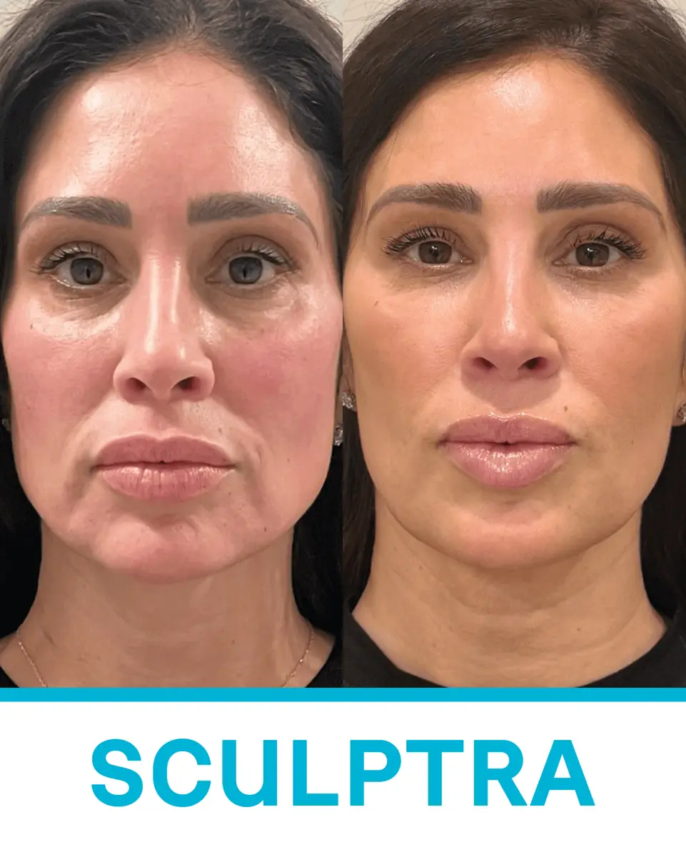 Antes y después de Sculptra, bioestimulador de colágeno — paciente real