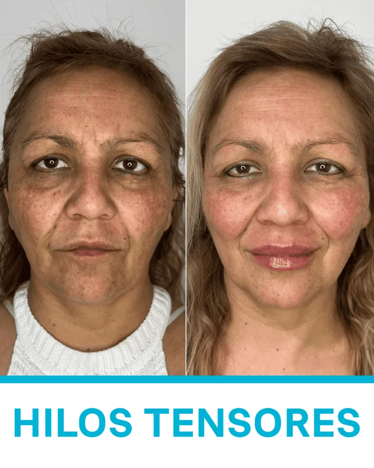 Hilos Tensores