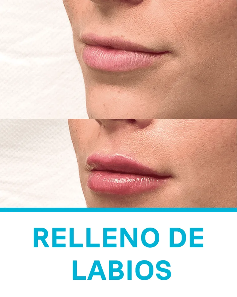 Relleno de Labios