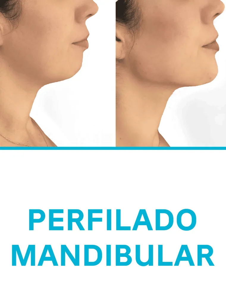 Perfilado Mandibular