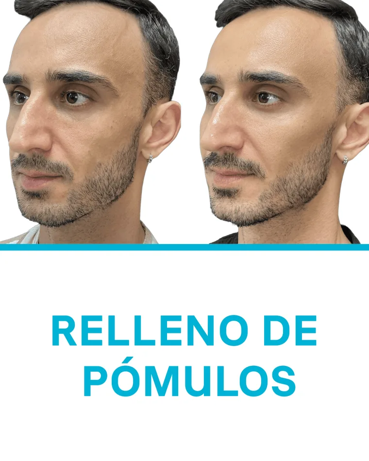 Relleno de Pómulos