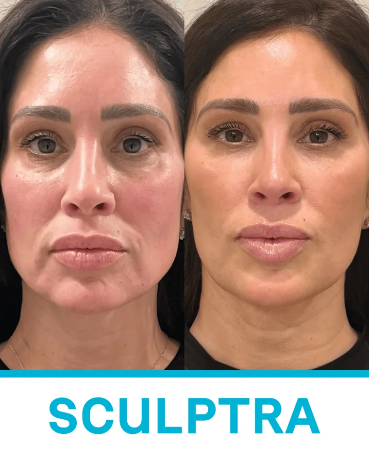 Sculptra