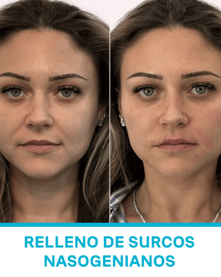 Relleno de Surcos Nasogenianos